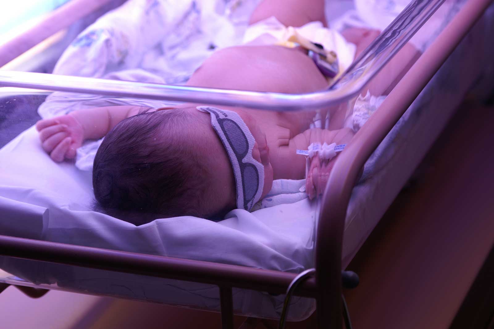 Jaundice in Newborns