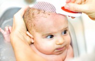 Cradle Cap